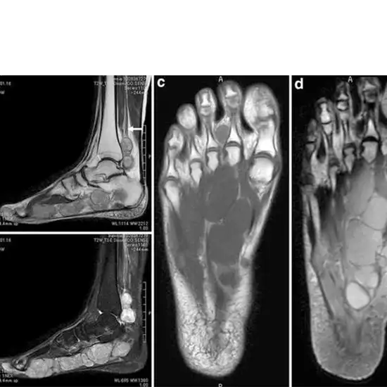 mri right foot with contrast